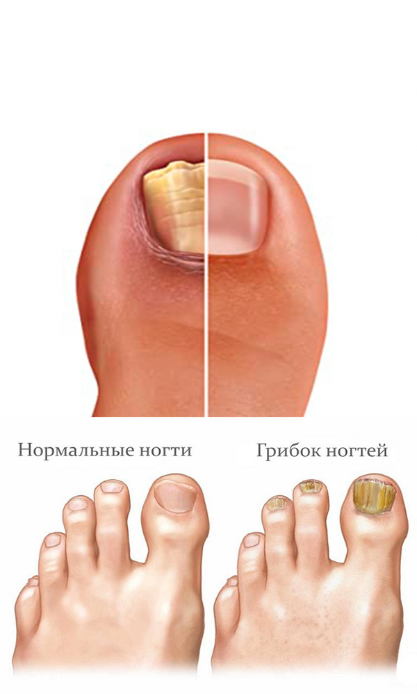 Грибок ногтевых пластинок — симптомы и способы лечения онихомикоза в клинике целт