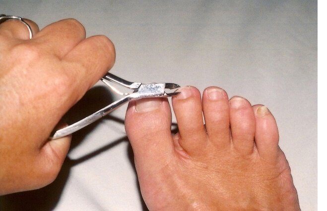 Как размягчить и подстричь ногти на ногах у пожилого человека?