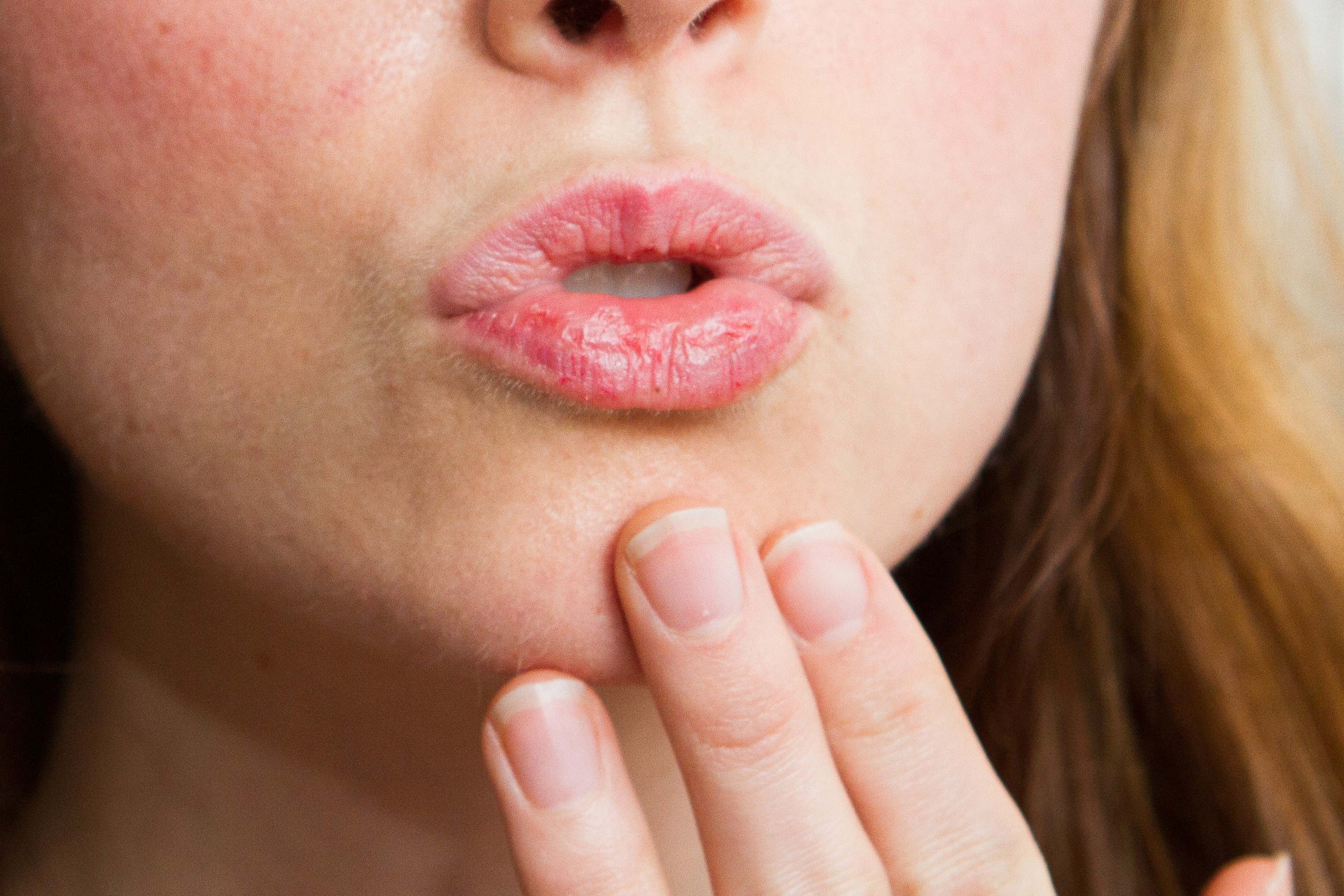 Шелушатся губы: что делать и как лечить, чтобы избежать трещин и воспаления