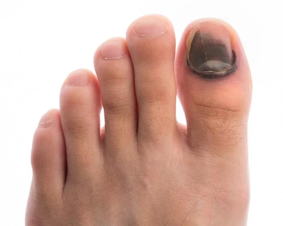 Почему синеют ногти на больших пальцах ног: причины и лечение