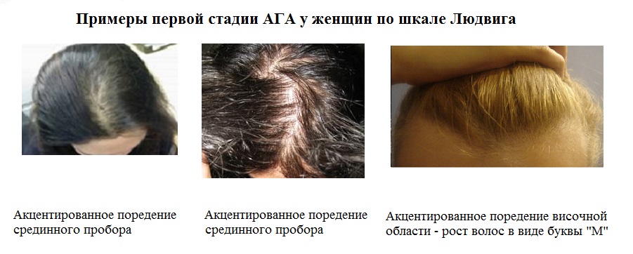 Выпадение волос не в андрогенной зоне