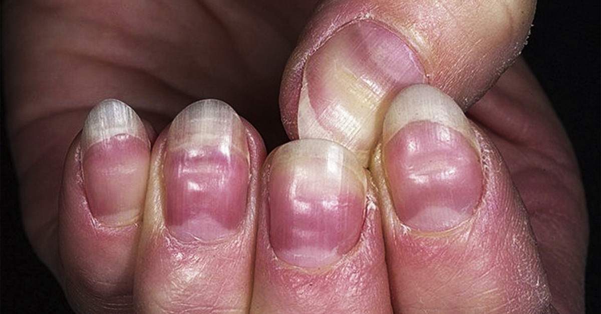 Черные полоски на ногтях: опасны или нет, надо ли лечить и чем это делать - beauty hub