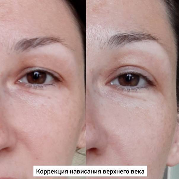Массаж век: как делать процедуру для подтяжки в домашних условиях, видео, техника стеклянной палочкой, для поднятия верхнего нависшего века, от отечности и другие