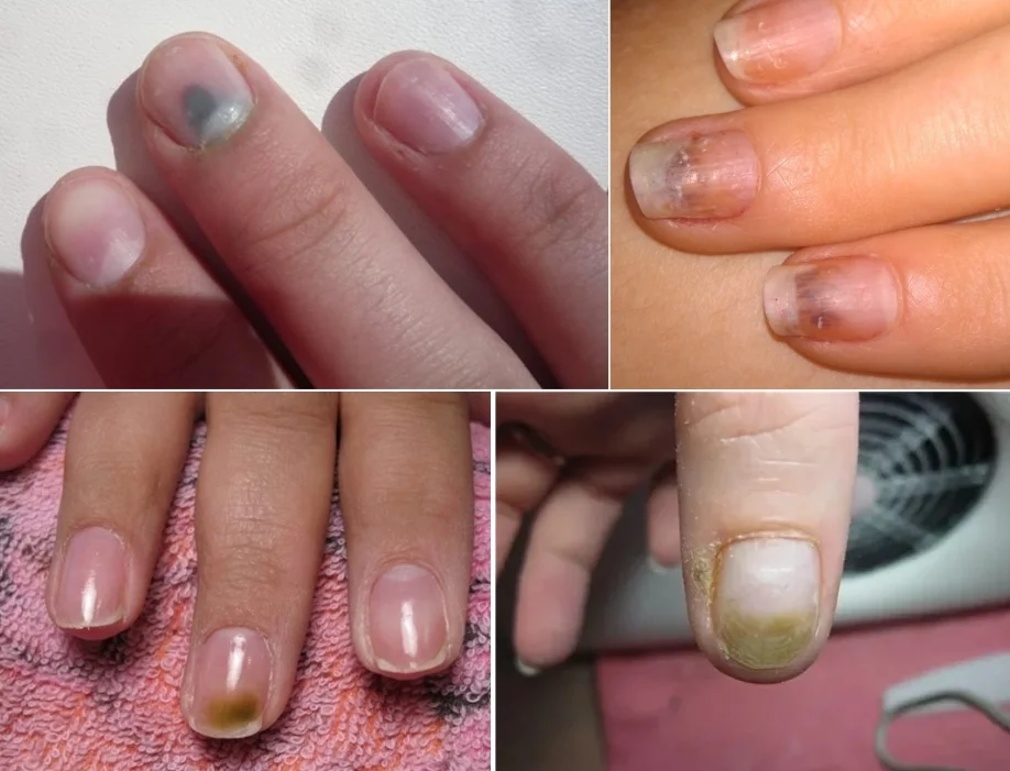 Как вылечить ногти после наращивания гелем? - новая косметология