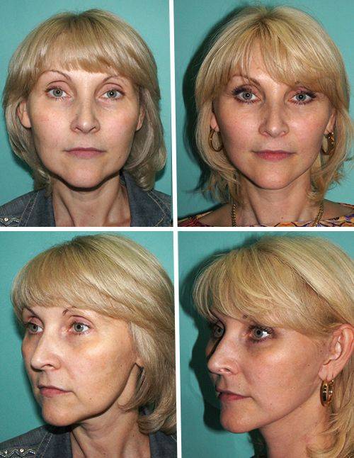 Подтяжка лица: фото до и после — институт пластической хирургии на трубной
