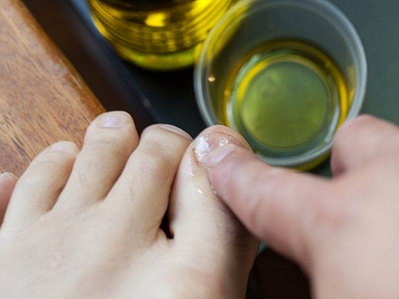 Лечение грибка ногтей уксусом в домашних условиях: самые быстрые способы