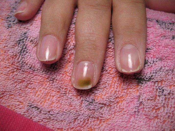 Инфекция, отслойки и микротрещины: как шеллак может навредить вашим ногтям
