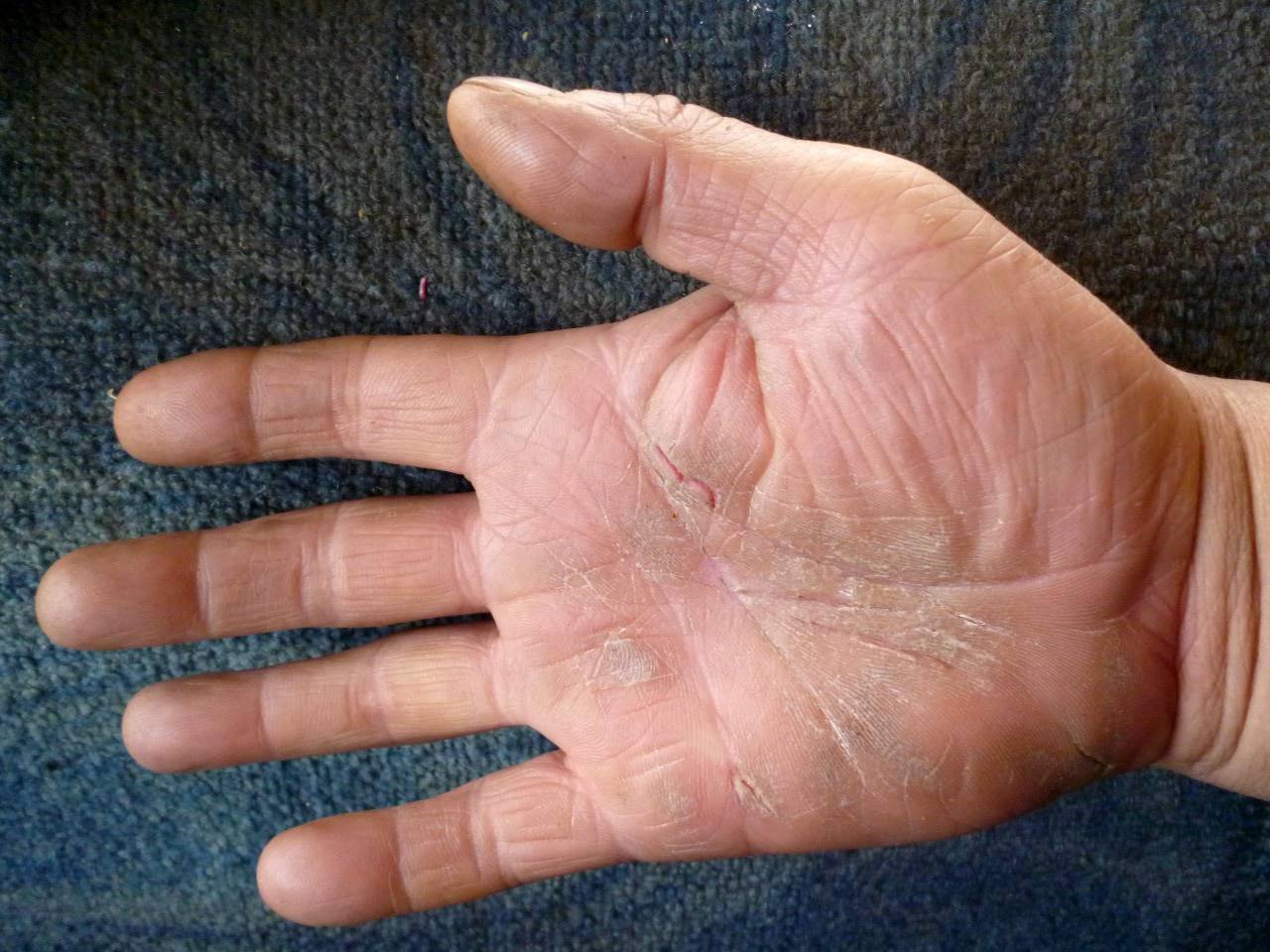 Псориаз на руках - как лечить, причины и симптомы заболевания
