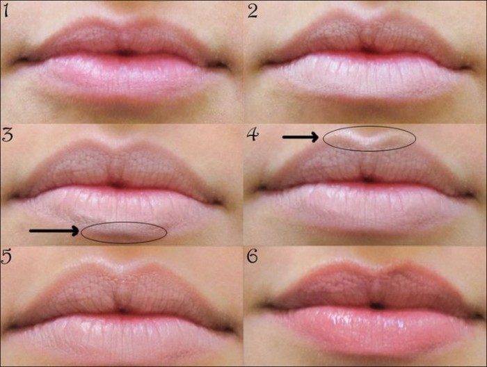 Увеличение губ: какие формы создают с помощью инъекций и пластики? | часто задаваемые вопросы об инъекционной косметологии