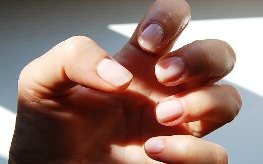 Заусенцы на пальцах: причины появления и лечение