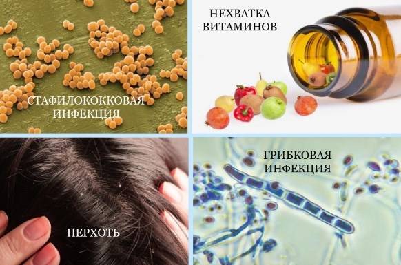 Псориаз на голове - как лечить, причины и симптомы заболевания
