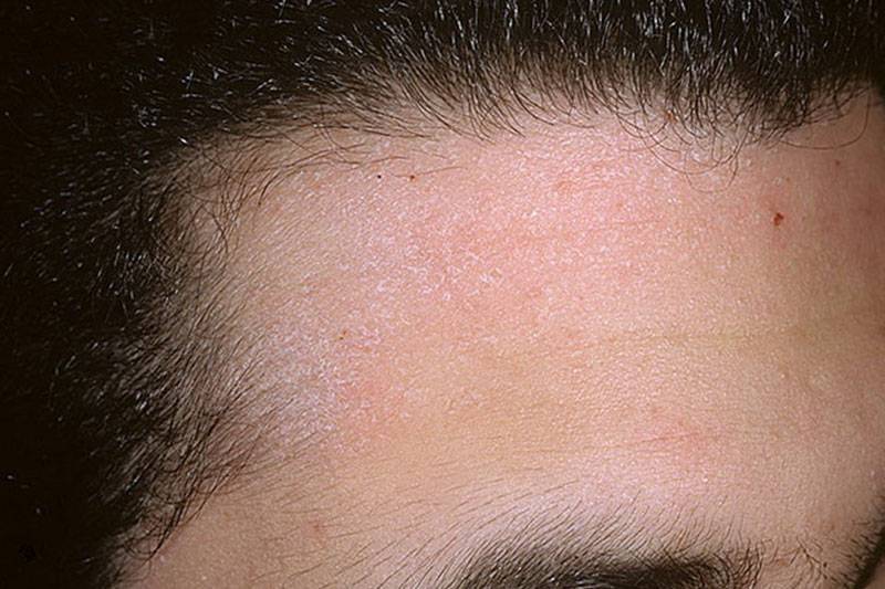 Себорея кожи головы: лечение, причины
