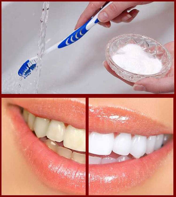 Как отбелить зубы без вреда (быстро и эффективно)?