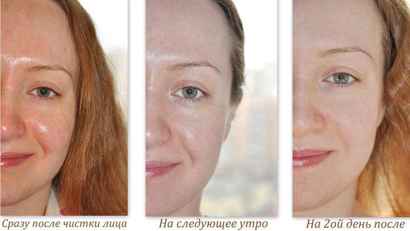 Домах сразу после того. Лицо после чистки лица. Чистка лица до и после фото. Кожа до и после чистки лица.