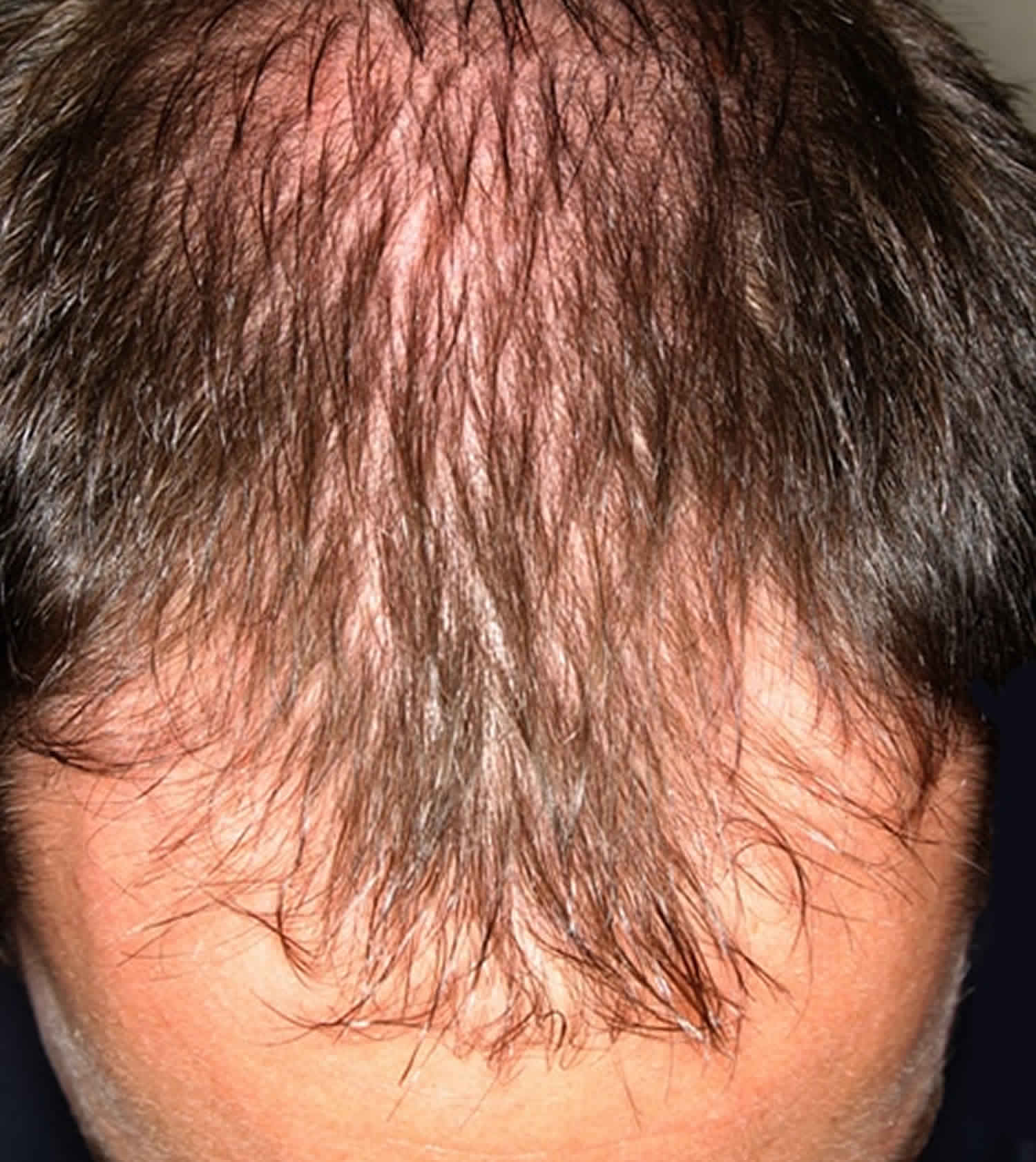 Выпадение волос у мужчин в молодом возрасте
