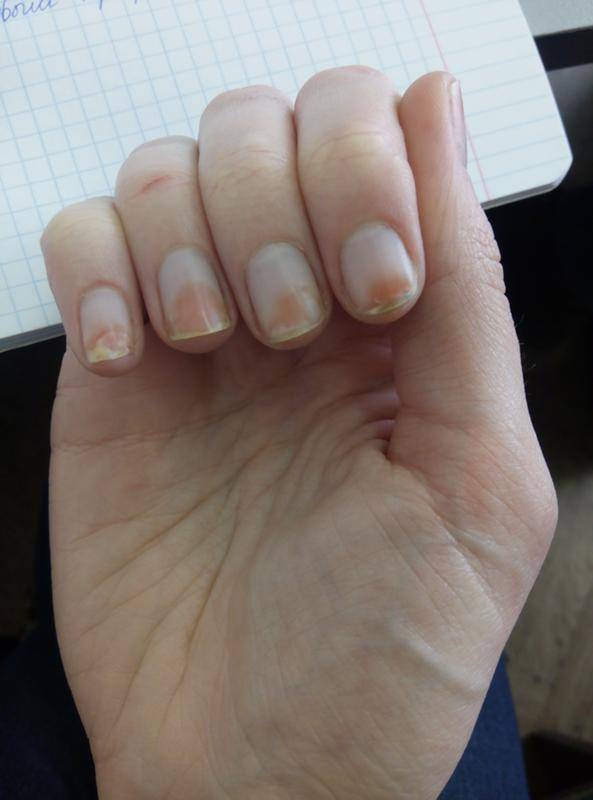 ᐉ вредно или полезно наращивание ногтей? наращивание ногтей гелем: способы, особенности и последствия ➡ klass511.ru