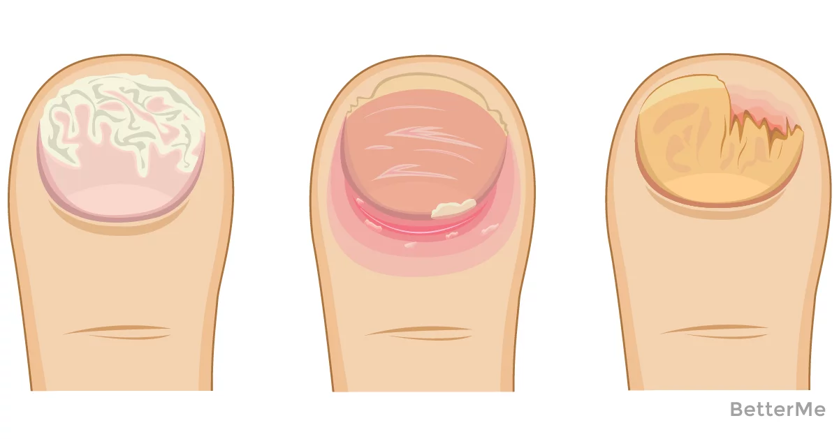 Грибок ногтей, лечение. причины и симптомы грибка ногтей.