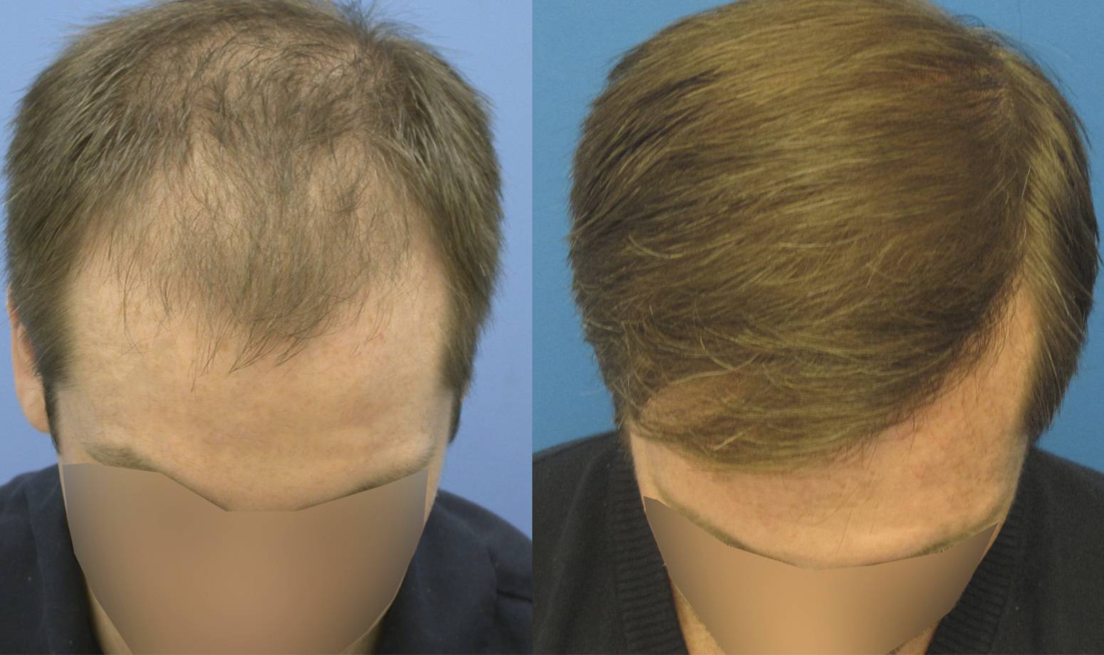 Андрогенное алопеция (облысение у мужчин): причины, симптомы, лечение и профилактика - клиника «доктор волос»