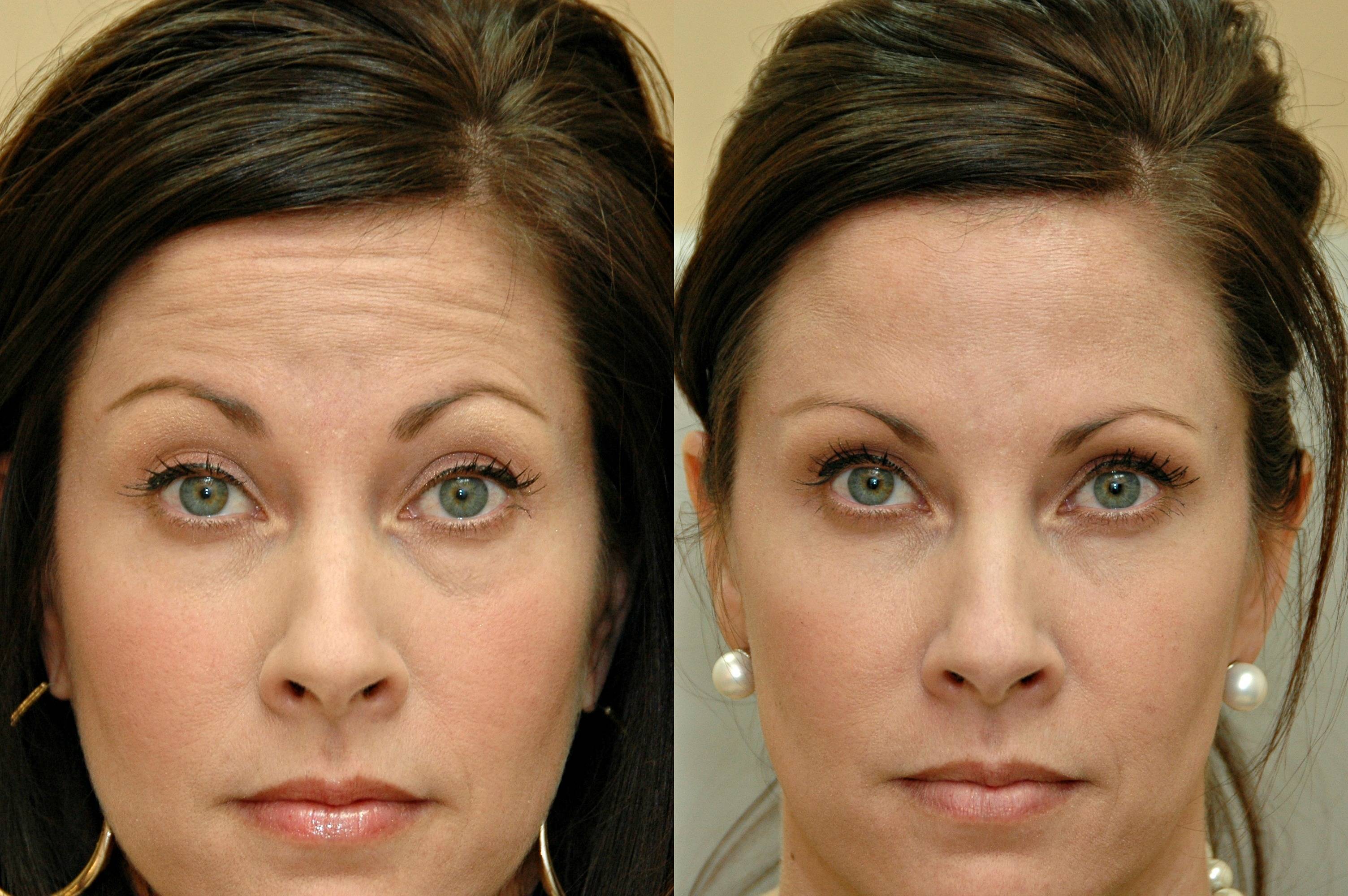 Ботокс: лицо до и после процедуры, что делает ботокс с лицом
