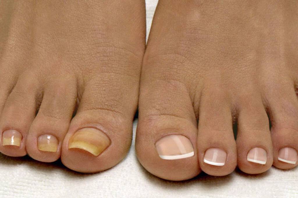 Чем опасен грибок ногтей. грибковое заболевание кожи. грибок ногтей. микоз