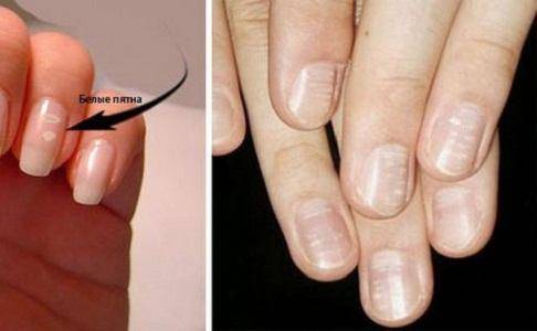 На ногтевой пластине белые пятна у грудничка. почему появляются белые полоски на ногтях: лечение