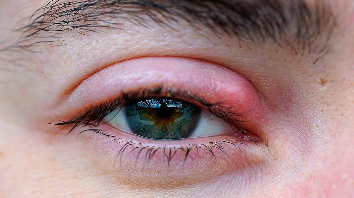 Зуд и покраснение вокруг глаз: причины, лечение и диагностика