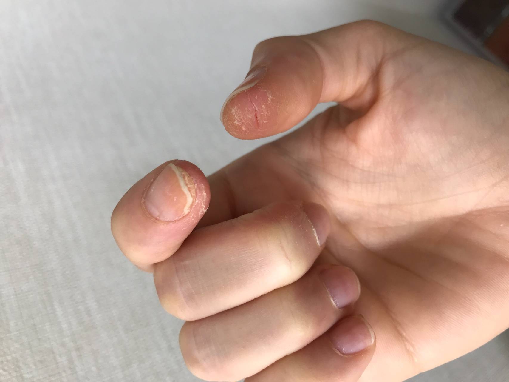 Почему шелушится кожа на ладонях рук: причины и что делать, если сохнут пальцы у женщин и мужчин, лечение очень сильного шелушения в одном месте, как избавиться и чем лечить