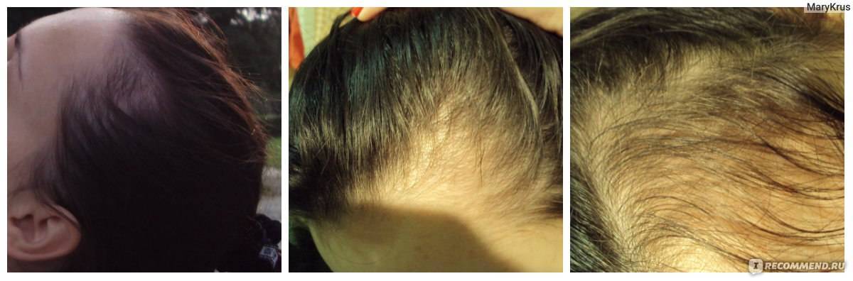 Как справиться с выпадением волос после родов и кормления грудью - центр эстетической медицины