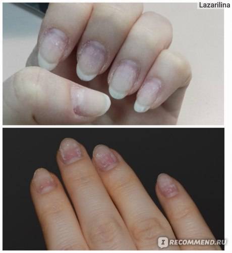 Что происходит с ногтями после наращивания: вред от процедуры | красивые ногти - дополнение твоего образа