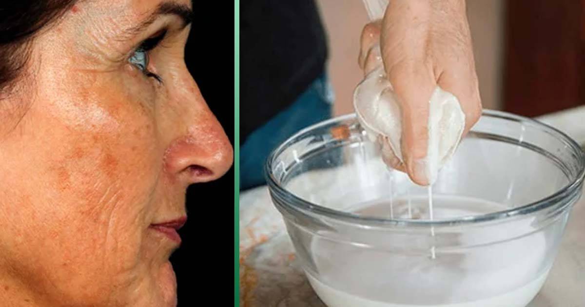 Как убрать возрастные пигментные пятна на лице: лучшие процедуры эстетической косметологии