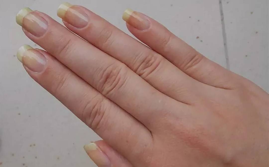 Почему желтеют ногти на руках у женщин и мужчин: причина