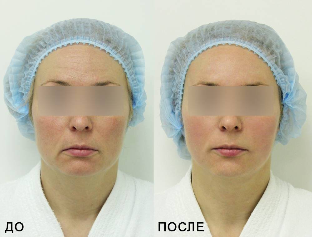 Круговая подтяжка лица (фейслифтинг) - хирургическая методика удаления лишней кожи и жировой клетчатки