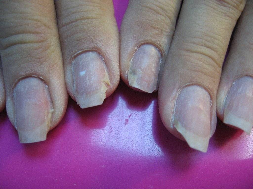 Восстановление ногтей после наращивания: лечение пластин и уход в домашних условиях