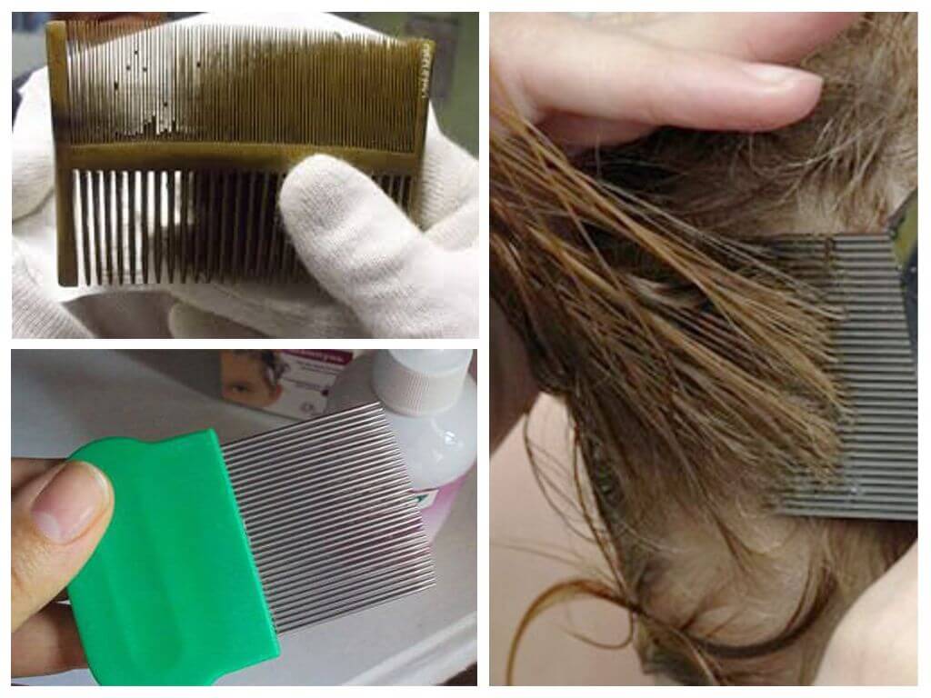 Как развести уксус для ополаскивания волос от вшей и гнид