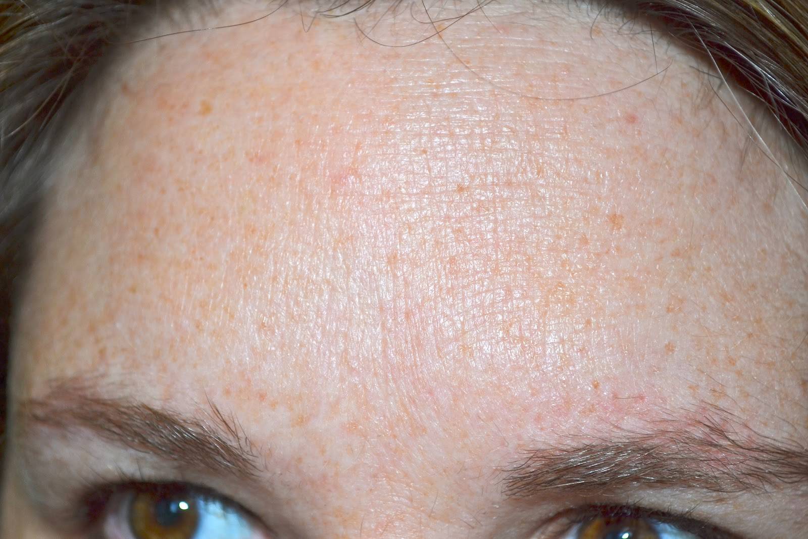 Базальноклеточный рак кожи: лечение и прогнозы при базальноклеточном раке кожи, базальноклеточная карцинома кожи фото | клиники «евроонко»