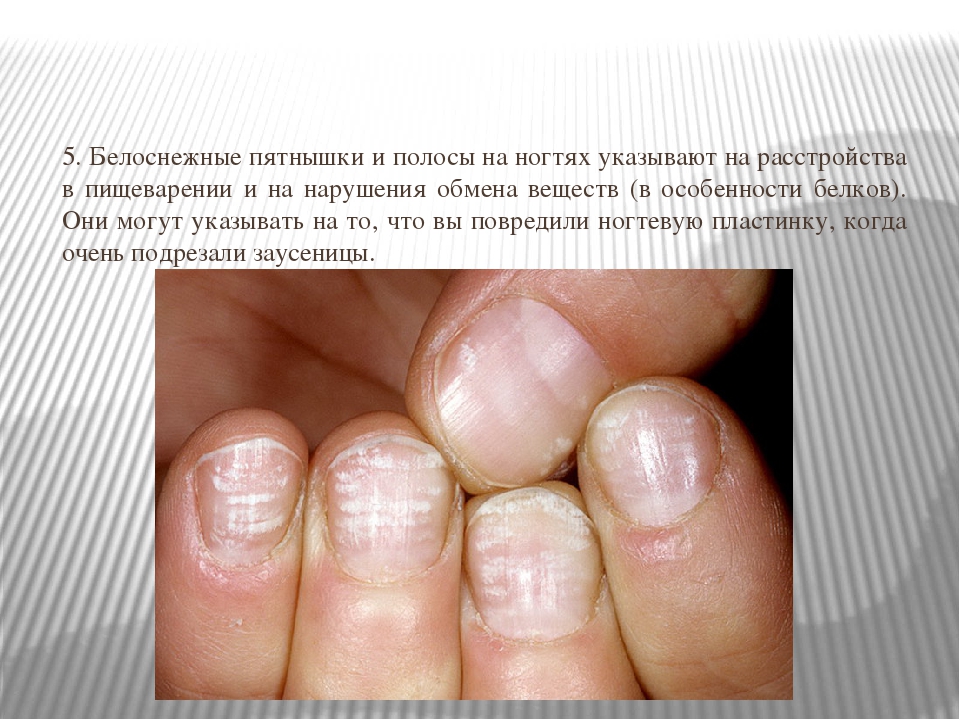 Ребристые ногти на руках, причины и лечение