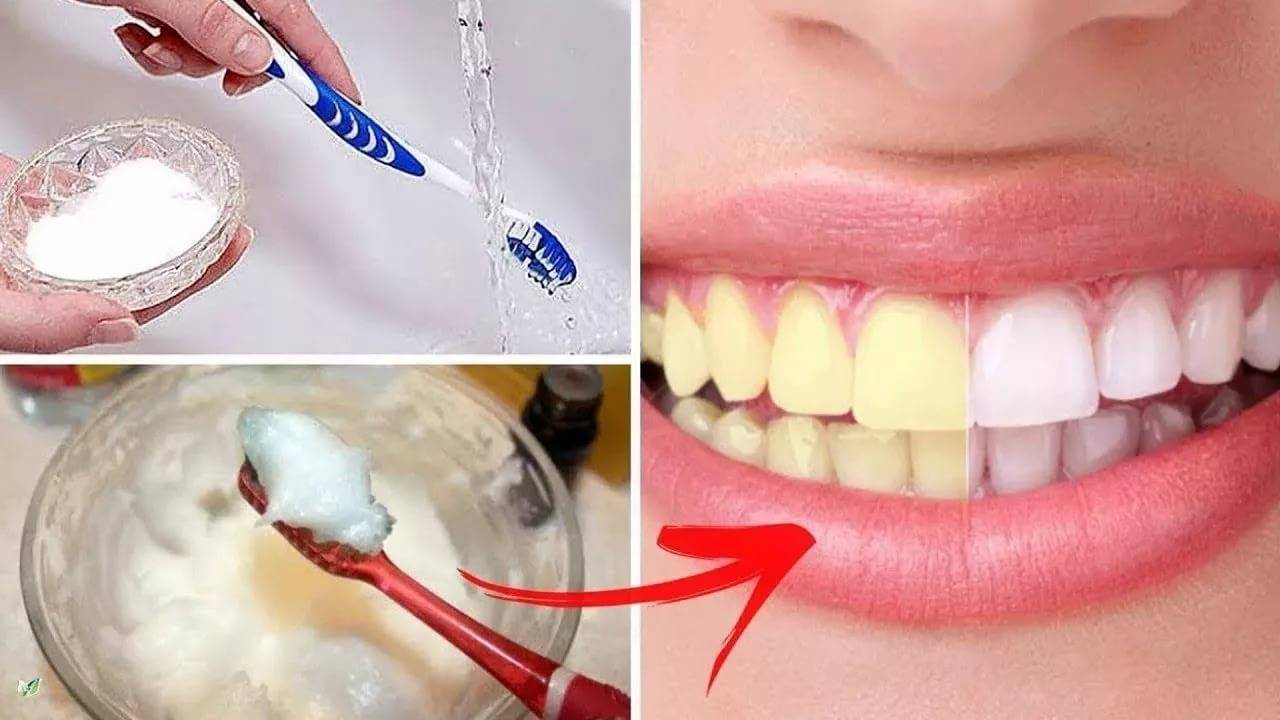Отбеливание зубов содой: можно ли чистить их с её помощью в домашних условиях, польза и вред