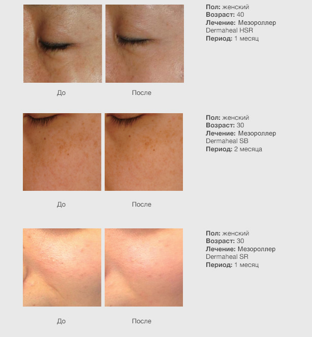 Дермахил от мешков под глазами. отзывы косметологов, фото до и после. мезотерапия hsr