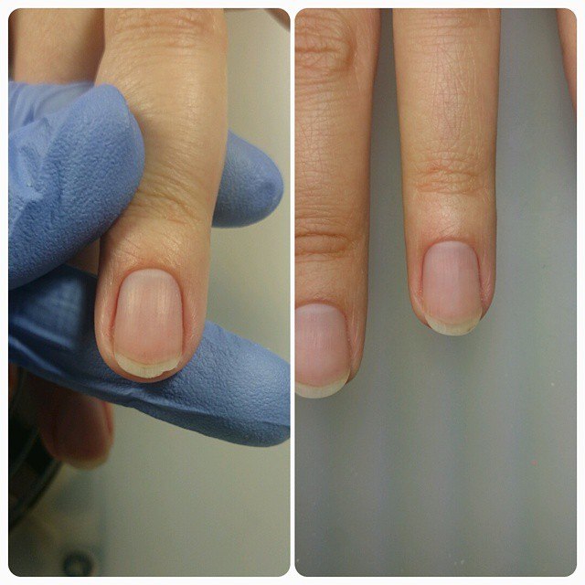 К чему снятся поломанные ногти. Наращивание ногтей до и после. Тонкая ногтевая пластина.