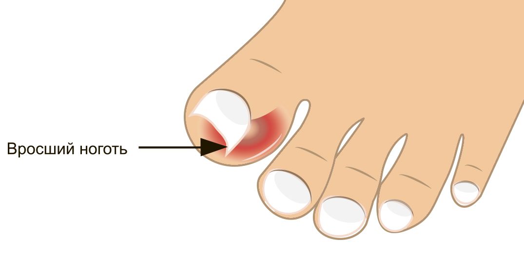 Как прирастить ноготь к ногтевому ложу