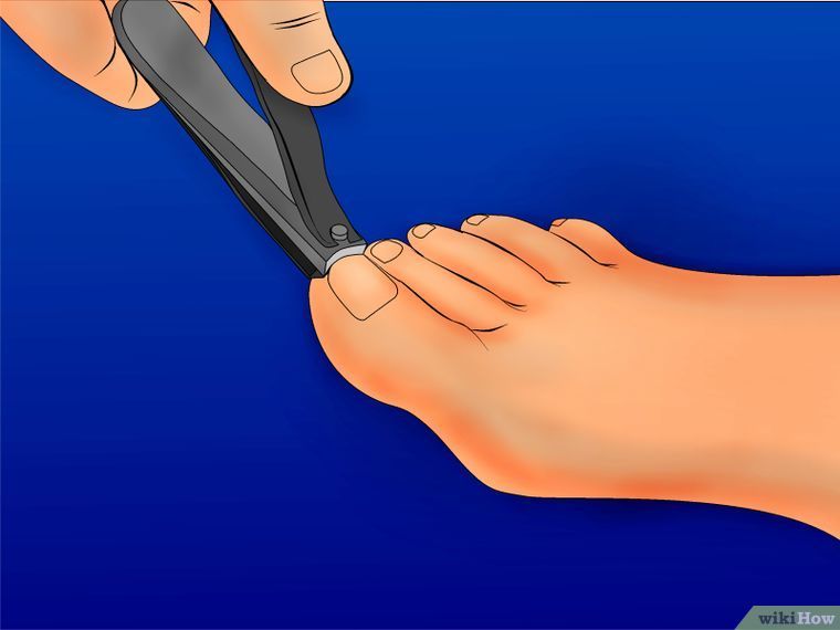 Как обрезать вросший ноготь | пилочка
