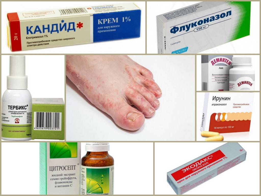 Онихомикоз - симптомы, лечение, препараты, народные средства, причины и профилактика