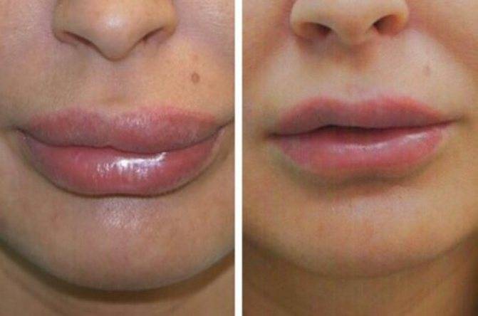 Как вывести гиалуроновую кислоту из губ