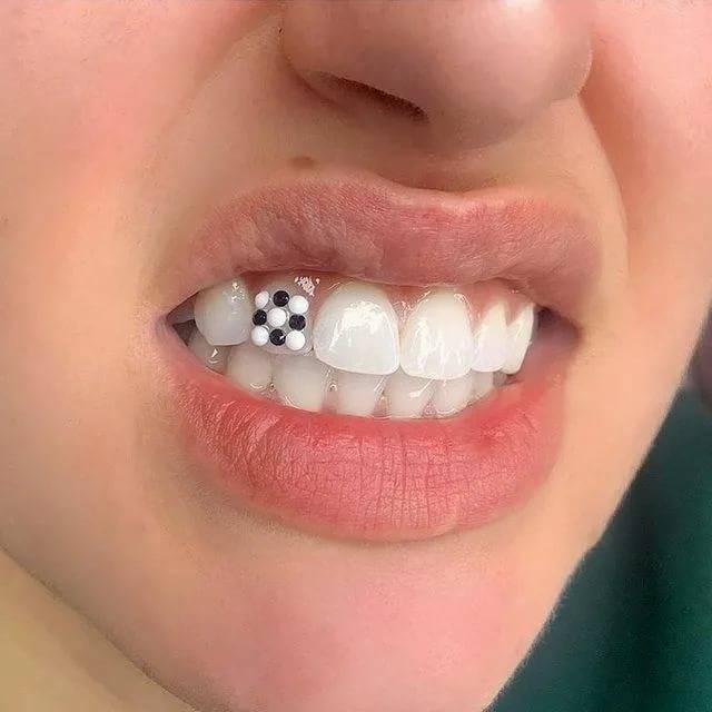 Скайс на зуб (фото): что это такое - процесс установки искусственного бриллианта | spacream.ru