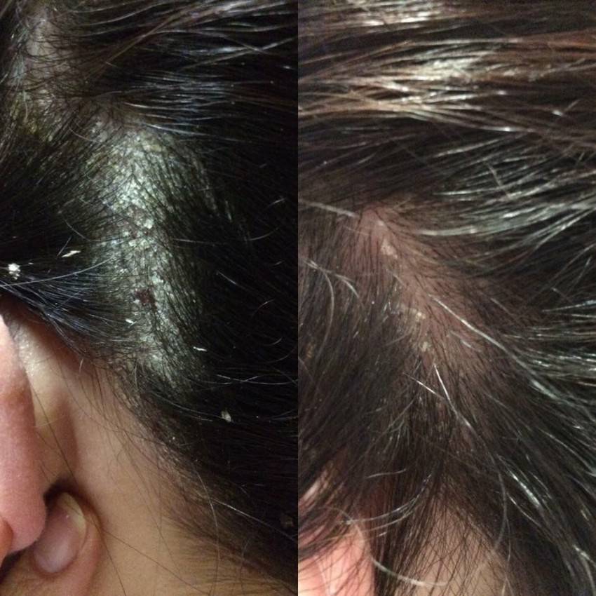 Псориаз волосистой части головы – лечение псориаза головы – симптомы и причины псориаза на голове - клиника «доктор волос»