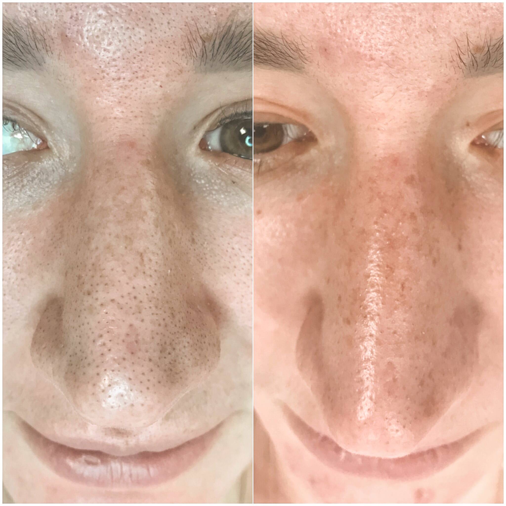 Атравматическая чистка кожи лица: отзывы, что это такое, фото