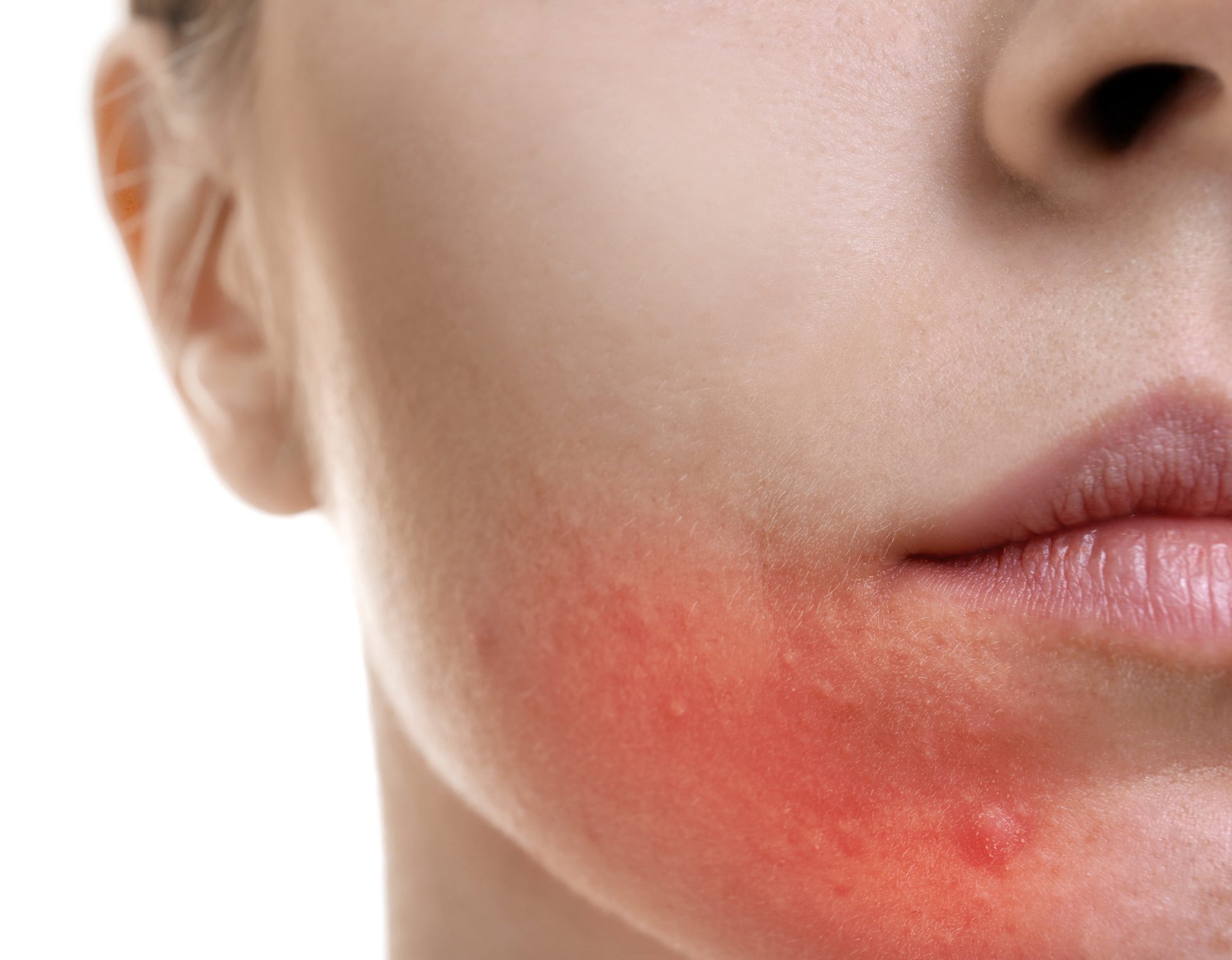 Веки чешутся и шелушатся: лечение покраснения кожи вокруг глаз и отека