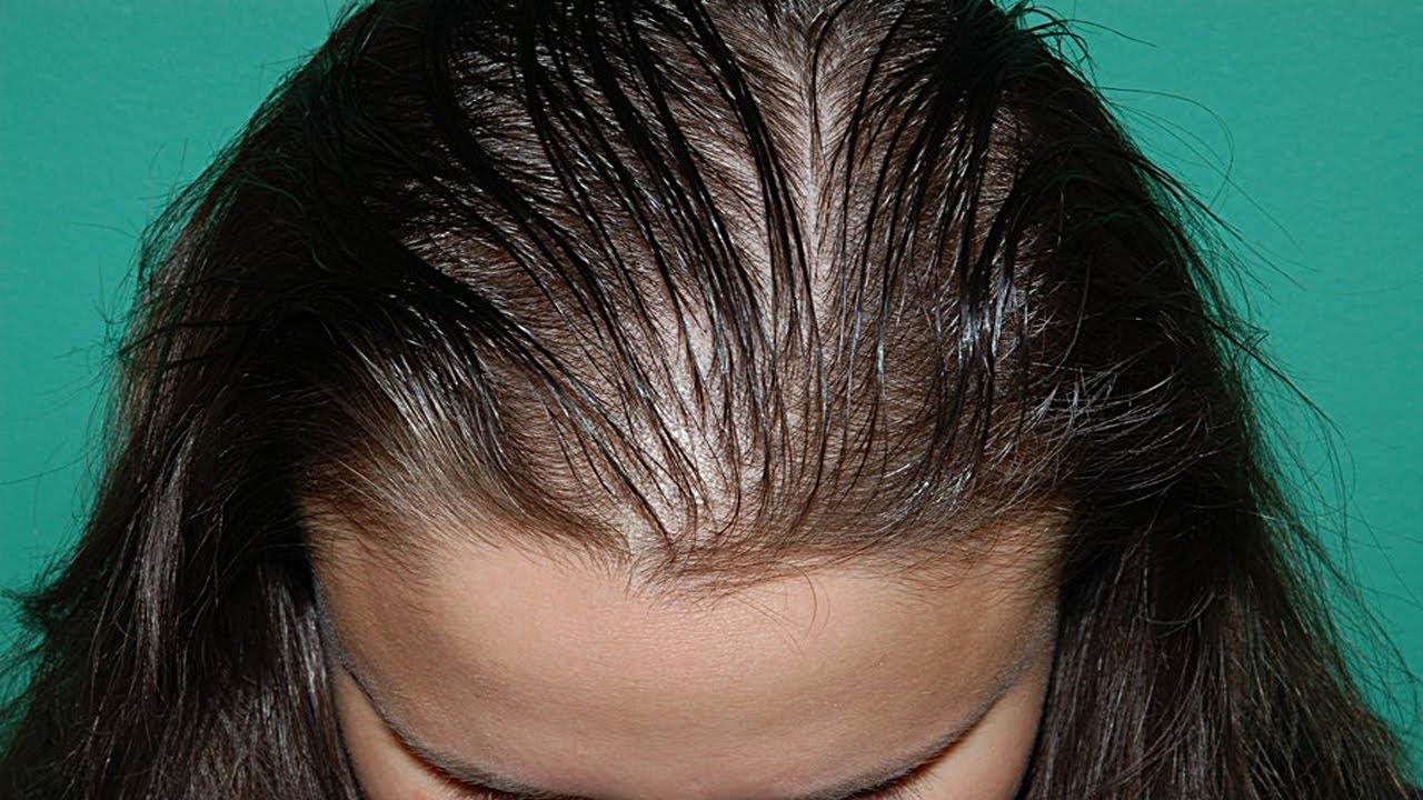 Алопеция: как сохранить свои волосы