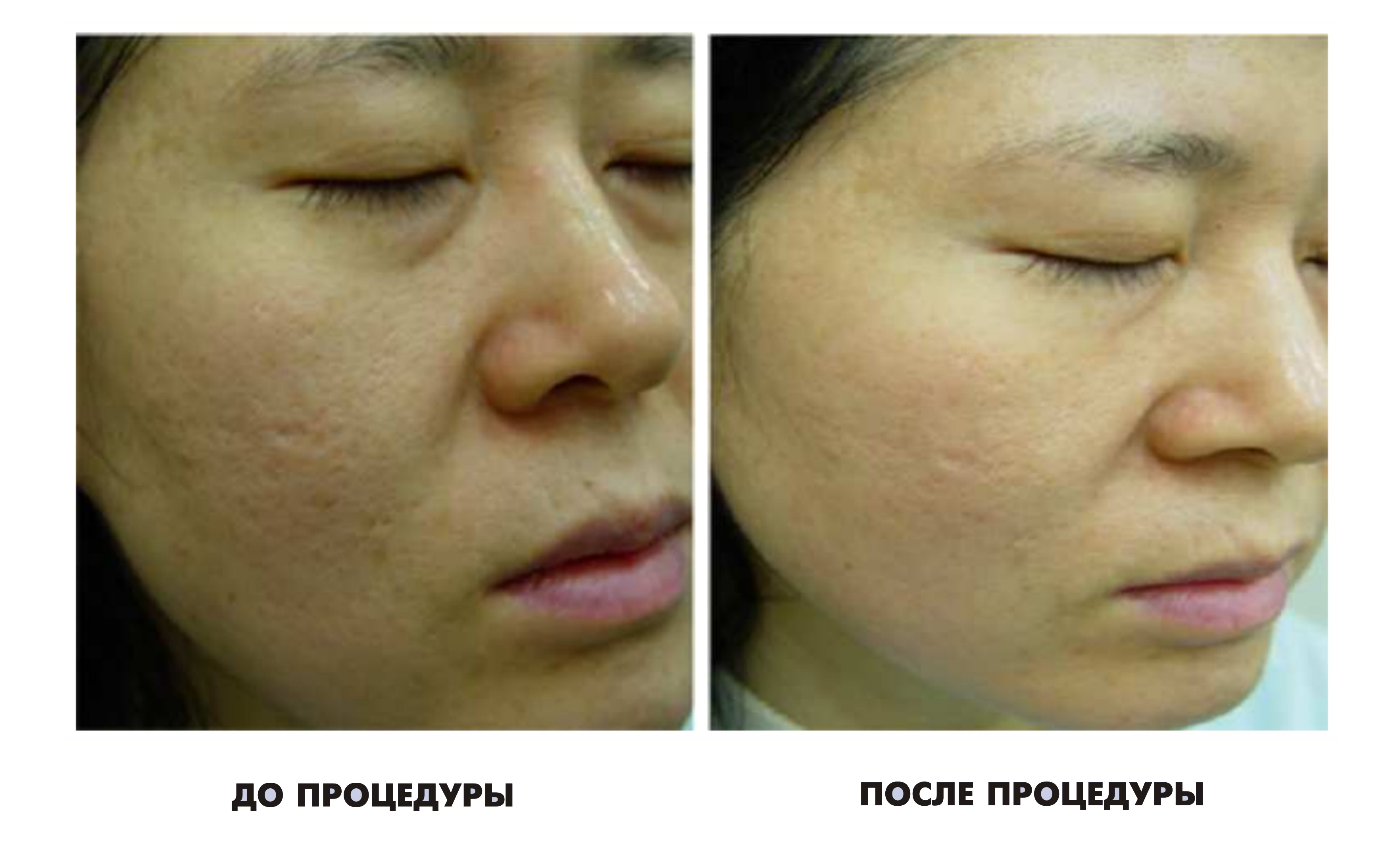 Как убрать шрамы на лице в домашних условиях - coolaser clinic