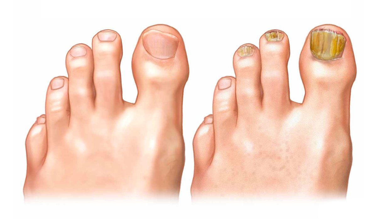Онихомикоз (грибок ногтей) – причины, виды, симптомы, диагностика, лечение и профилактика